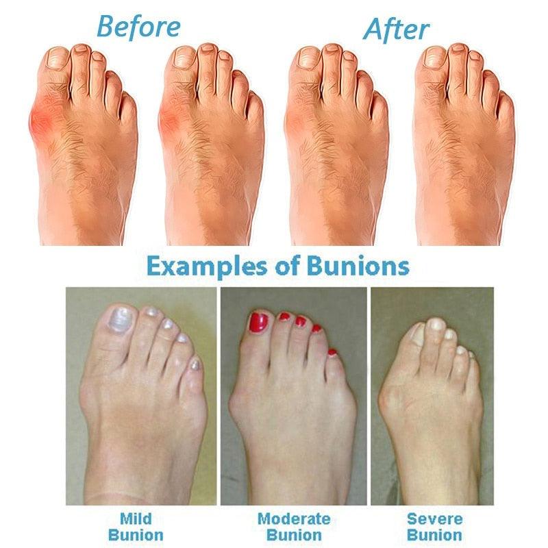 Woman's Comfortable Orthopedic Sandals for Bunion Relief and Support