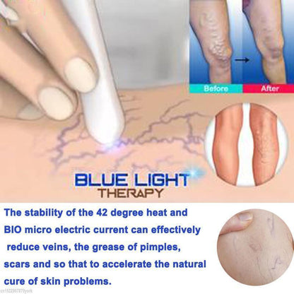 Spider Vein Treatment Pen - Blue Light Laser Therapy Device