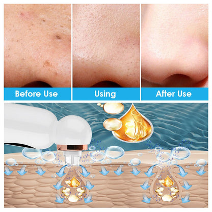 Hydrodermabrasion Blackhead Remover for Clearer, Smoother Skin