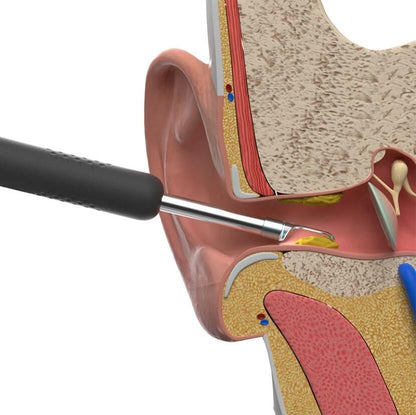 Intelligent Earwax Removal Otoscope for Safe Ear Cleaning