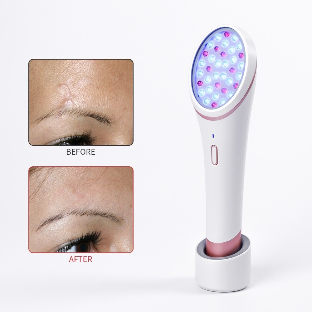 LED Photon Light Therapy Device for Acne Treatment