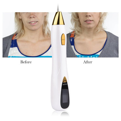 Mole Removal Pen for Safe and Effective Skin Treatment