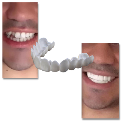 Perfect Smile Dental Coverage: Comfortable, High-Quality Veneers for You