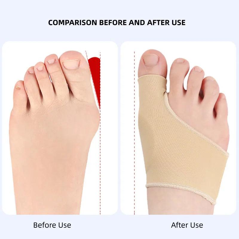 Toe Separator and Bunion Corrector for Foot Pain Relief