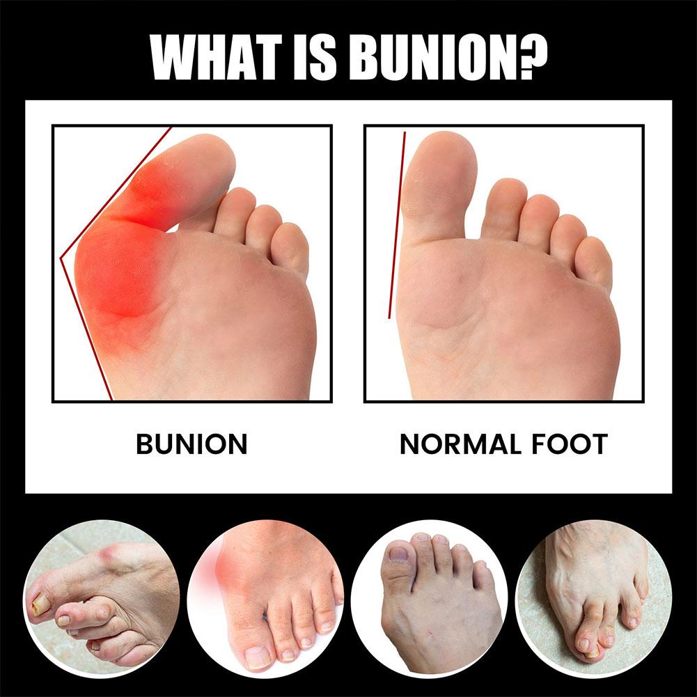 Comfortable Outdoor Socks for Bunion Pain and Stiffness Relief