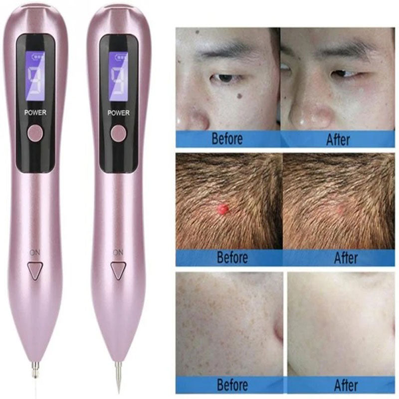 Plasma Pen for Effortless Skin Tag and Mole Removal