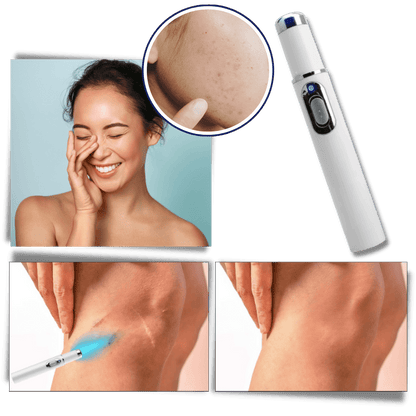 Blue Laser Pen for Effective Dark Spot Removal