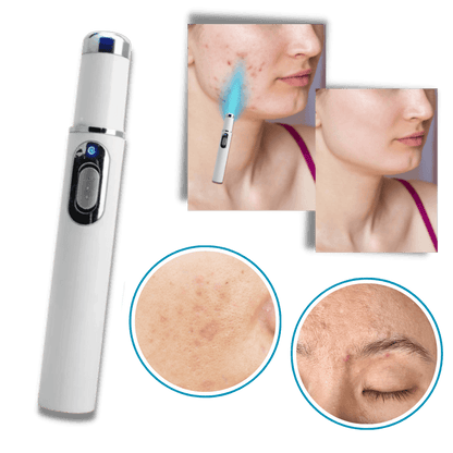 Blue Laser Pen for Effective Dark Spot Removal