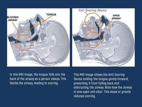 Apnea Tongue Stabilizer for Improved Sleep Quality and Comfort